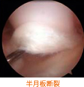 半月板断裂