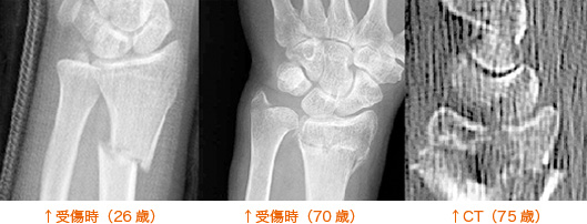 受傷時（26歳） / 受傷時（70歳） / CT（75歳）