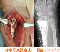 術中写真固定後 / 術後レントゲン