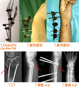 DispoFix (Synthes TM) / 創外固定 / 創外固定 / CT / 術前x-p / 術後x-p