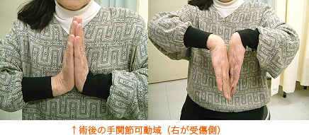 術後の手関節可動域（右が受傷側）